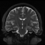 Brain MRI (Coronal Plane)